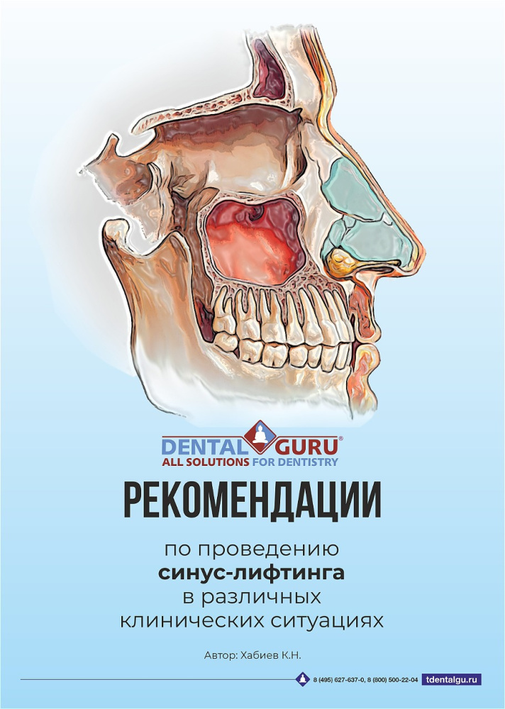 Руководство по проведению синус-лифтинга